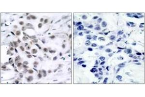 Immunohistochemistry analysis of paraffin-embedded human breast carcinoma tissue, using Chk1 (Ab-317) Antibody. (CHEK1 抗体  (AA 286-335))