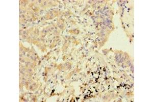 Immunohistochemistry of paraffin-embedded human lung cancer using ABIN7154785 at dilution of 1:100 (GBP6 抗体  (AA 401-600))