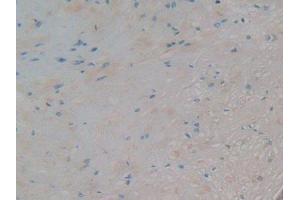 IHC-P analysis of Human Prostate Cancer Tissue, with DAB staining. (AZGP1 抗体)