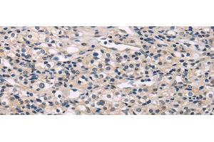 Immunohistochemistry of paraffin-embedded Human prostate cancer using MED28 Polyclonal Antibody at dilution of 1/30 (MED28 抗体)