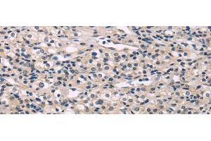 Immunohistochemistry of paraffin-embedded Human prostate cancer using MED28 Polyclonal Antibody at dilution of 1/30 (MED28 抗体)