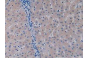IHC-P analysis of Human Liver Cancer Tissue, with DAB staining. (Vitamin D-Binding Protein 抗体  (AA 395-474))