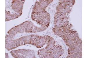IHC-P Image Immunohistochemical analysis of paraffin-embedded human colon carcinoma, using OTC, antibody at 1:250 dilution. (OTC 抗体)