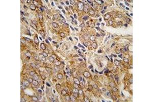 IHC analysis of FFPE human prostate carcinoma tissue stained with TRPM8 antibody (TRPM8 抗体  (AA 926-956))