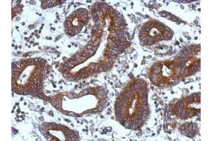 IHC-P Image Immunohistochemical analysis of paraffin-embedded human colon carcinoma, using TIE1, antibody at 1:500 dilution. (TIE1 抗体)