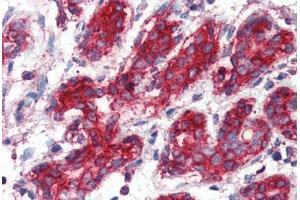 Human Breast (formalin-fixed, paraffin-embedded) stained with SOD2 antibody ABIN396955 at 1:50 followed by biotinylated anti-mouse IgG secondary antibody ABIN481714, alkaline phosphatase-streptavidin and chromogen. (SOD2 抗体)