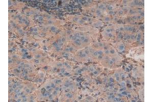Detection of b2M in Human Liver cancer Tissue using Polyclonal Antibody to Beta-2-Microglobulin (b2M) (beta-2 Microglobulin 抗体  (AA 22-119))