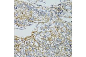 Immunohistochemistry of paraffin-embedded human gastric cancer using CHMP4B antibody (ABIN4903276) at dilution of 1:100 (40x lens). (CHMP4B 抗体)