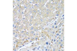 Immunohistochemistry of paraffin-embedded human liver cancer using PPBP antibody at dilution of 1:100 (40x lens). (CXCL7 抗体)