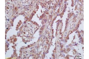 Formalin-fixed and paraffin embedded human lung carcinoma  labeled with Rabbit Anti-GAS 6 Polyclonal Antibody, Unconjugated (ABIN873146) at 1:200 followed by conjugation to the secondary antibody and DAB staining (GAS6 抗体  (AA 551-650))