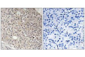 Immunohistochemistry analysis of paraffin-embedded human prostate carcinoma tissue using AMOTL1 antibody. (AMOTL1 抗体  (Internal Region))