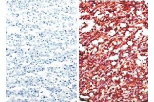 Paraffin embedded AIDS-associated Burkitt lymphoma tissue array was stained with anti-CXCR5 (right) and Rat IgG2b-UNLB (大鼠 IgG2b isotype control (Cy5))