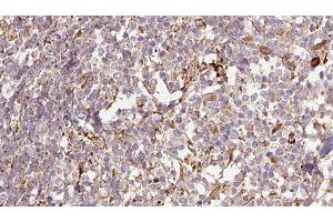 ABIN6276757 at 1/100 staining Human Melanoma tissue by IHC-P. (MMP13 抗体  (N-Term))