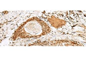 Immunohistochemistry of paraffin-embedded Human esophagus cancer tissue using SNAPC1 Polyclonal Antibody at dilution of 1:40(x200) (SNAPC1 抗体)