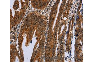 Immunohistochemistry of Human gastric cancer using GH2 Polyclonal Antibody at dilution of 1:60 (Growth Hormone 2 抗体)