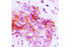 Immunohistochemical analysis of CD9 staining in human prostate cancer formalin fixed paraffin embedded tissue section. (CD9 抗体  (Center))