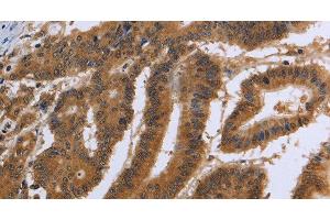 Immunohistochemistry of paraffin-embedded Human colon cancer using DUSP8 Polyclonal Antibody at dilution of 1:30 (DUSP8 抗体)