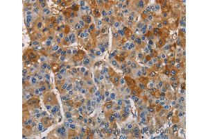 Immunohistochemistry of Human thyroid cancer using CST4 Polyclonal Antibody at dilution of 1:60 (CST4 抗体)