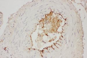 Anti- Adiponectin antibody, IHC(P) IHC(P): Human Mammary Cancer Tissue (ADIPOQ 抗体  (AA 19-244))