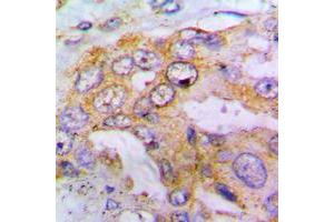 Immunohistochemical analysis of EIF4G1 (pS1148) staining in human lung cancer formalin fixed paraffin embedded tissue section. (EIF4G1 抗体  (pSer1148))