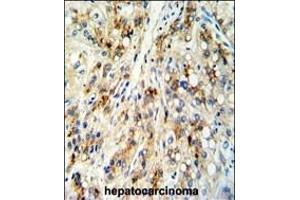 Formalin-fixed and paraffin-embedded human hepatocarcinoma reacted with CECR5 Antibody (Center), which was peroxidase-conjugated to the secondary antibody, followed by DAB staining. (CECR5 抗体  (AA 164-190))