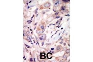 Immunohistochemistry (Paraffin-embedded Sections) (IHC (p)) image for anti-Receptor Tyrosine Kinase-Like Orphan Receptor 2 (ROR2) (AA 915-943), (C-Term) antibody (ABIN392045)