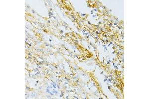 Immunohistochemistry of paraffin-embedded human lung cancer using TGFBI antibody. (TGFBI 抗体  (AA 481-683))