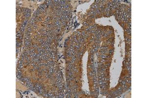 Immunohistochemistry of Human liver cancer using MAS1 Polyclonal Antibody at dilution of 1:50 (MAS1 抗体)