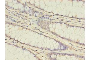 Immunohistochemistry of paraffin-embedded human colon cancer using ABIN7145104 at dilution of 1:100