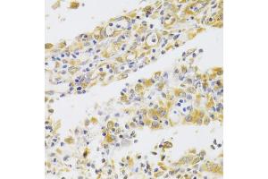 Immunohistochemistry of paraffin-embedded human gastric cancer using PA2G4 Antibody (ABIN1876564) at dilution of 1:100 (40x lens). (PA2G4 抗体)