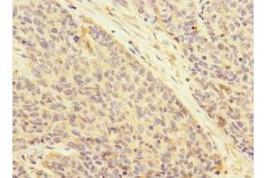 Immunohistochemistry of paraffin-embedded human ovarian cancer using ABIN7145065 at dilution of 1:100 (Attractin 抗体  (AA 84-350))