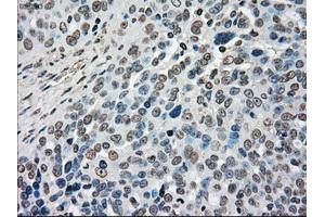 Immunohistochemical staining of paraffin-embedded Adenocarcinoma of ovary tissue using anti-MAP2K4mouse monoclonal antibody. (MAP2K4 抗体)