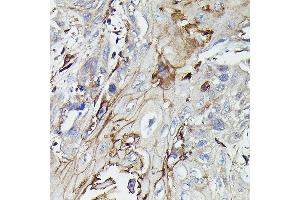 Immunohistochemistry of paraffin-embedded human esophageal cancer using PDGFRB Rabbit pAb (ABIN6134579, ABIN6145372 and ABIN7101437) at dilution of 1:100 (40x lens). (PDGFRB 抗体)