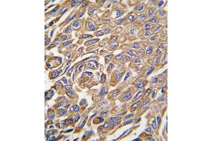 Formalin-fixed and paraffin-embedded human lung carcinoma tissue reacted with ALDH3A1 antibody (Center), which was peroxidase-conjugated to the secondary antibody, followed by DAB staining. (ALDH3A1 抗体  (AA 254-284))