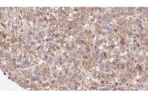 ABIN6279790 at 1/100 staining Human Melanoma tissue by IHC-P.