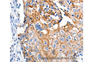 Immunohistochemistry of Human cervical cancer using CLDN1 Polyclonal Antibody at dilution of 1:150 (Claudin 1 抗体)