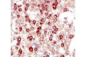 IHC testing of human hepatocarcinoma stained with SUMO2/3 antibody. (SUMO2/3 抗体  (AA 49-81))