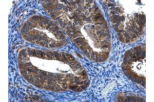 IHC-P Image FGD4 antibody [N1N3] detects FGD4 protein at cytoplasm in human endometrial cancer by immunohistochemical analysis.