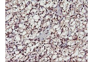 Immunohistochemical staining of paraffin-embedded Carcinoma of Human kidney tissue using anti-MGLL mouse monoclonal antibody. (MGLL 抗体)