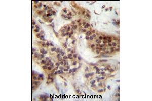 FOXA2 Antibody (Center ) (ABIN657130 and ABIN2846274) immunohistochemistry analysis in formalin fixed and paraffin embedded human bladder carcinoma followed by peroxidase conjugation of the secondary antibody and DAB staining. (FOXA2 抗体  (AA 134-163))