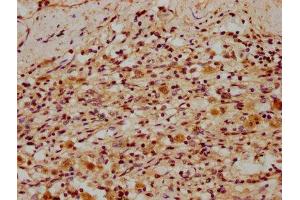 IHC image of ABIN7150293 diluted at 1:300 and staining in paraffin-embedded human lung cancer performed on a Leica BondTM system. (REV1 抗体  (AA 1035-1160))