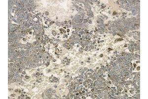 ABIN6259198 and ABIN6274317 at 1/100 staining human melanoma by IHC-P.