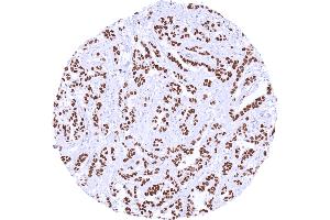 Invasive breast cancer of no special type NST with intense nuclear TRPS1 positivity Dilution 1:600 (Recombinant TRPS1 抗体  (AA 900-1100))