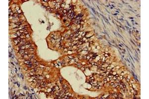 Immunohistochemistry of paraffin-embedded human colon cancer using ABIN7144771 at dilution of 1:100 (Astrotactin 2 抗体  (AA 108-272))