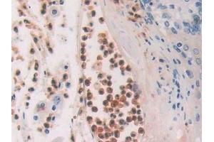 Detection of CDA in Human Skin cancer Tissue using Polyclonal Antibody to Cytidine Deaminase (CDA)
