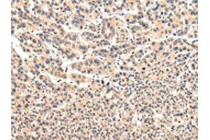 The image on the left is immunohistochemistry of paraffin-embedded Human liver cancer tissue using ABIN7131583(VPS37A Antibody) at dilution 1/20, on the right is treated with fusion protein. (VPS37A 抗体)