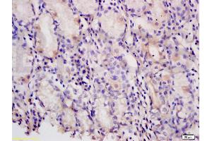 Formalin-fixed and paraffin embedded human gastric carcinoma tissue labeled with Anti-PAF Polyclonal Antibody, Unconjugated (ABIN737931) at 1:200 followed by conjugation to the secondary antibody and DAB staining (KIAA0101 抗体)