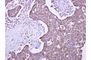 IHC-P Image Malectin antibody detects KIAA0152 protein at cytosol on human colon carcinoma by immunohistochemical analysis.