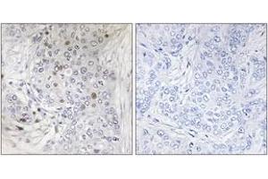 Immunohistochemistry analysis of paraffin-embedded human breast carcinoma tissue, using MAFF Antibody. (MafF 抗体  (AA 51-100))