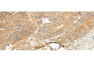 Immunohistochemistry of paraffin-embedded Human colorectal cancer tissue using ADGRF5 Polyclonal Antibody at dilution of 1:40(x200) (G Protein-Coupled Receptor 116 抗体)